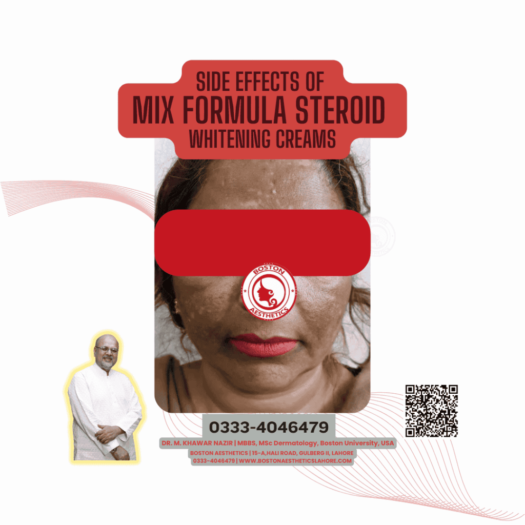 Image showing the side effects of mix formula steroid whitening creams, highlighting visible skin damage such as hyperpigmentation and uneven skin texture. Includes expert advice and contact information for Dr. M. Khawar Nazir, Boston Aesthetics Lahore.