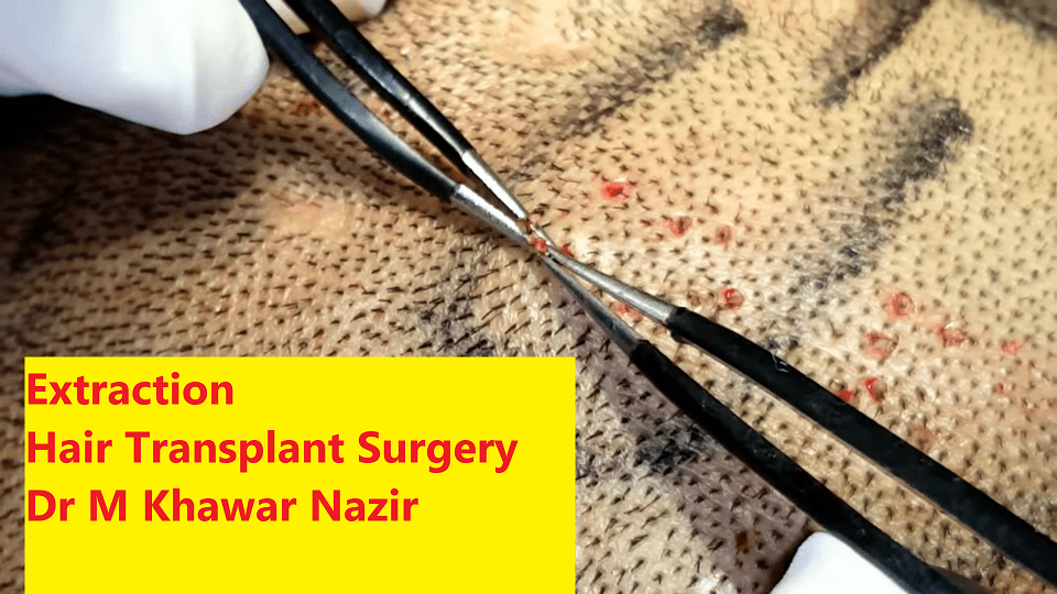 Extraction of hair grafts by American-Trained Dermatologist Dr. M. Khawar Nazir during Hair Transplant Surgery in Lahore