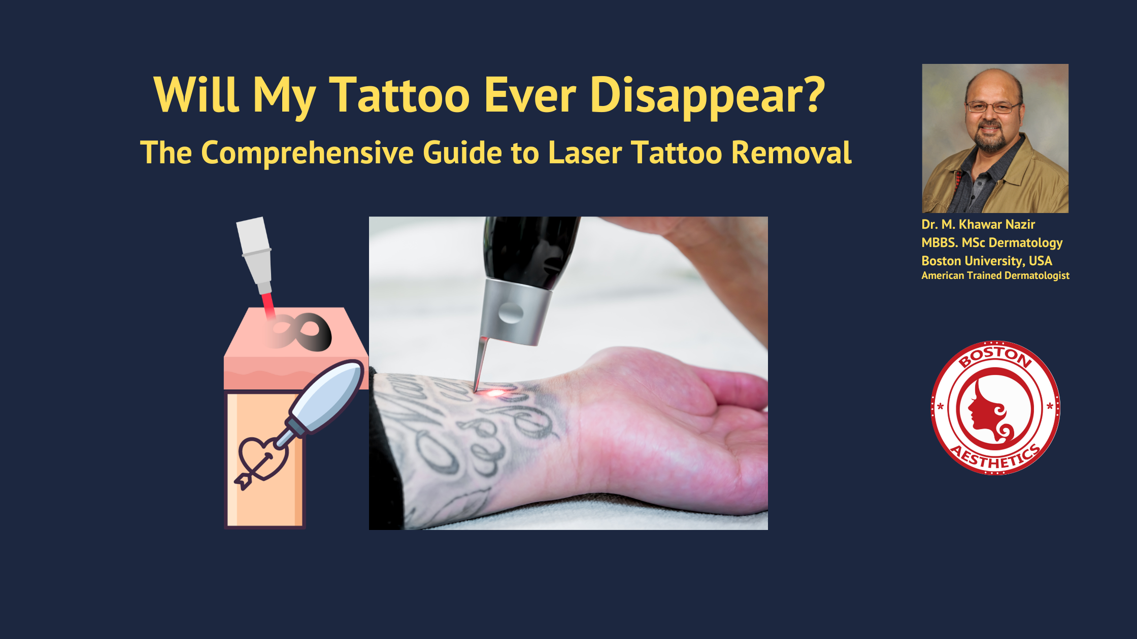 Will My Tattoo Ever Disappear? The Comprehensive Guide to Laser Tattoo ...