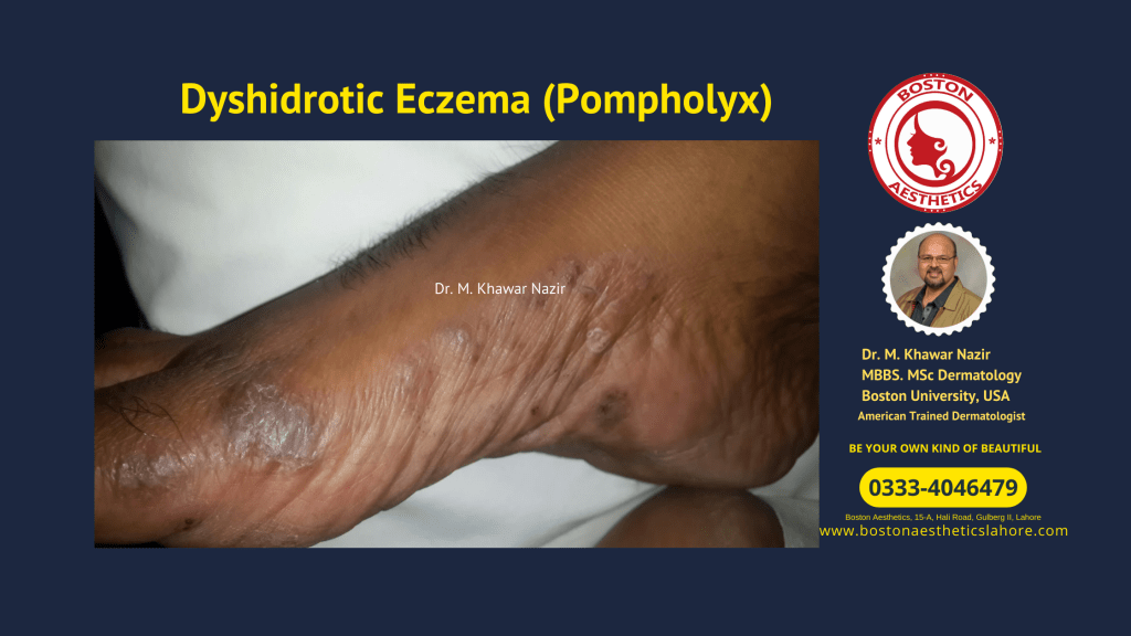Dyshidrotic Eczema (Pompholyx) | Dyshydritic Dermatitis