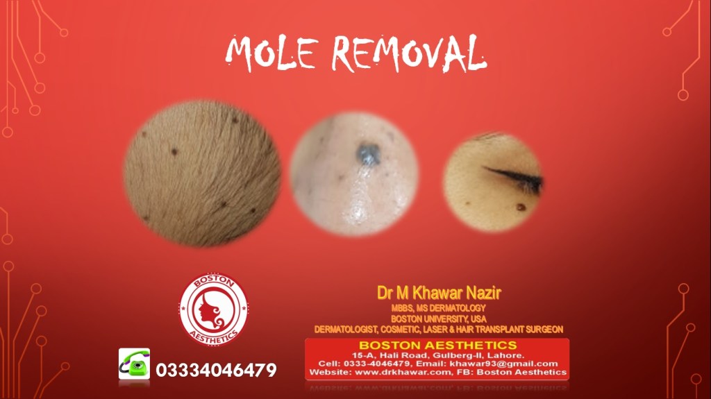 Mole Removal