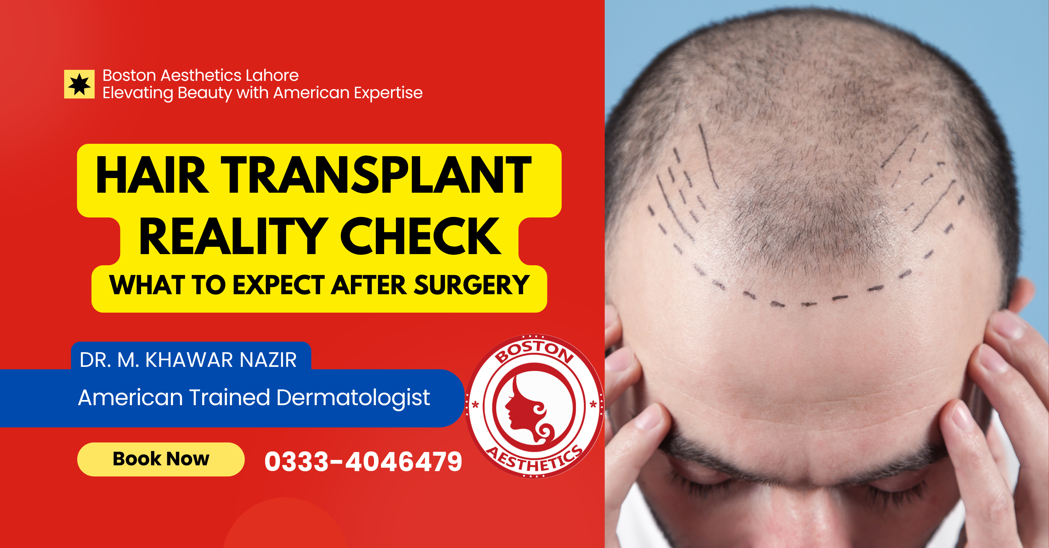 Hair Transplant Expectations vs. Reality