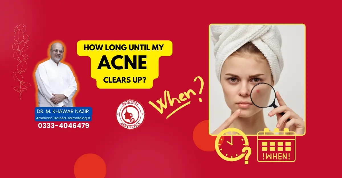 How Long Until My Acne Clears Up? (Lahore Answers!)