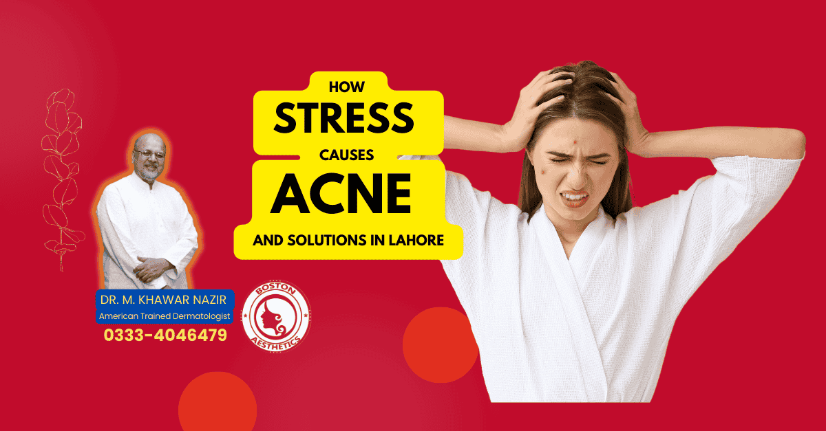 Stress, Acne & Solutions from Lahore’s Dermatology Expert
