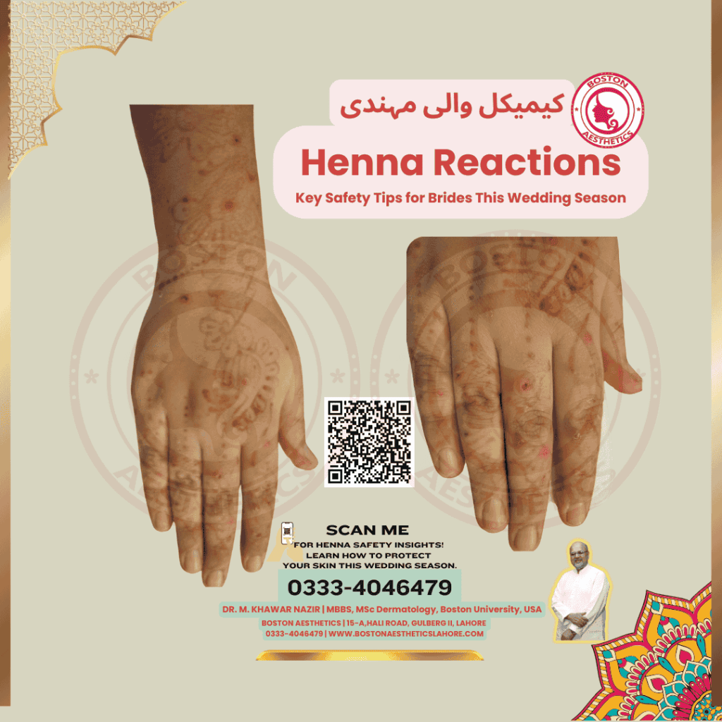 Image of hands showing henna reaction, QR code linking to blog post on henna safety tips by Dr. M. Khawar Nazir, American-trained dermatologist at Boston Aesthetics, Lahore.