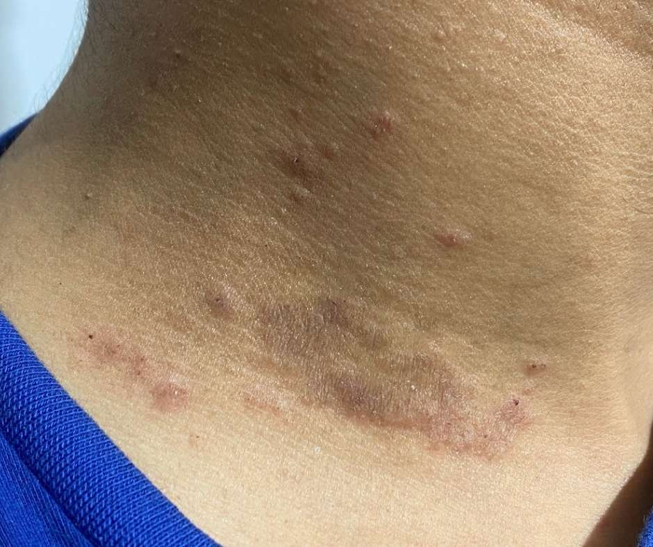 Close-up of eczema-prone skin on the neck, showing redness, dryness, and irritation. Learn 5 Essential Tips for Managing Eczema-Prone Skin in Lahore to relieve itching, strengthen the skin barrier, and prevent flare-ups. Expert guidance from Dr. M. Khawar Nazir at Boston Aesthetics, Lahore can help you achieve softer, healthier skin.