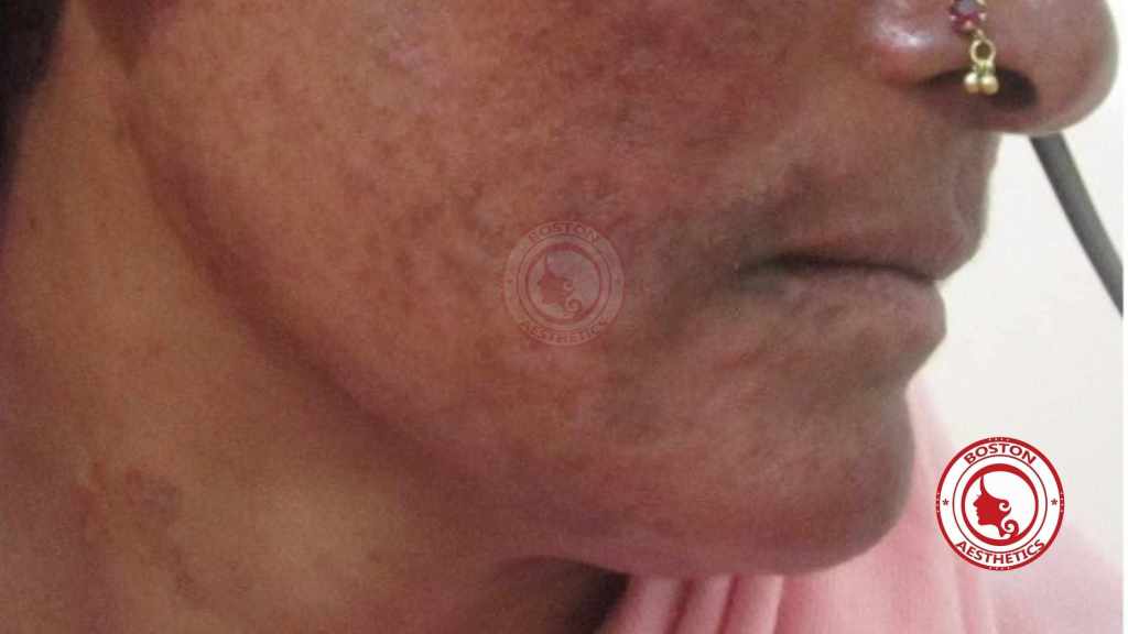 Visible skin damage revealing the harsh truths about mix formula steroid whitening creams used for skin lightening in Lahore