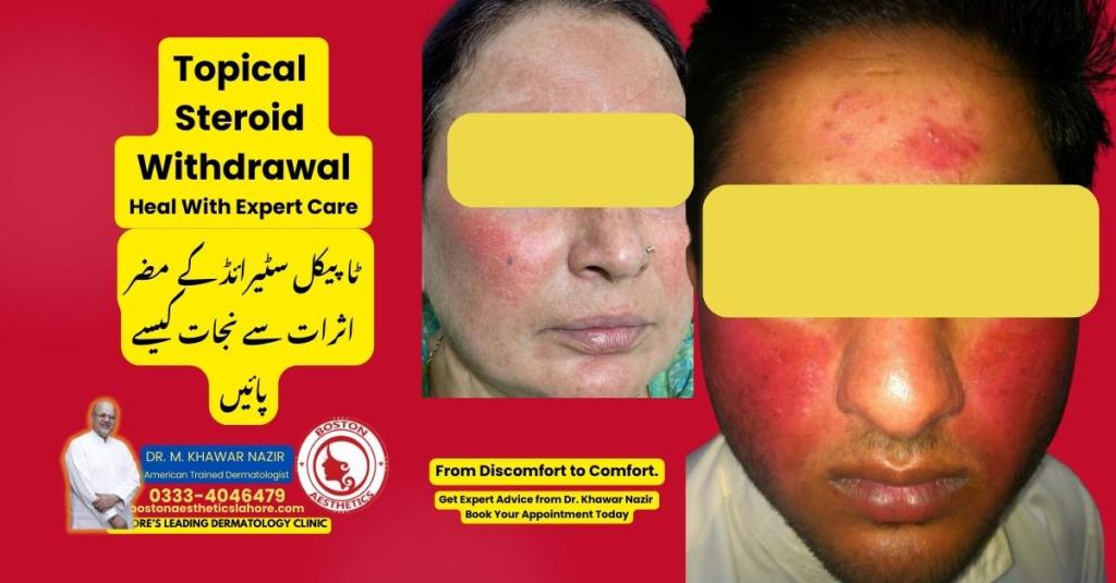Before and after topical steroid withdrawal symptoms on face showing redness and skin irritation treated by American-trained dermatologist in Lahore
