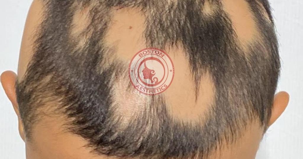 Close-up photograph of severe patchy hair loss due to alopecia areata, highlighting the emotional impact