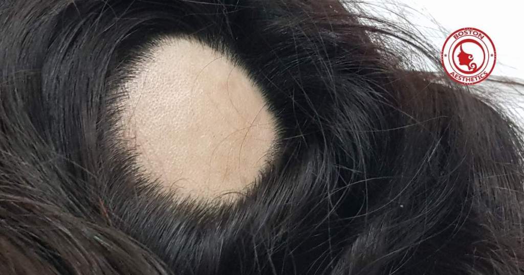 Close-up of a circular bald patch on a female scalp showing Alopecia Areata hair loss