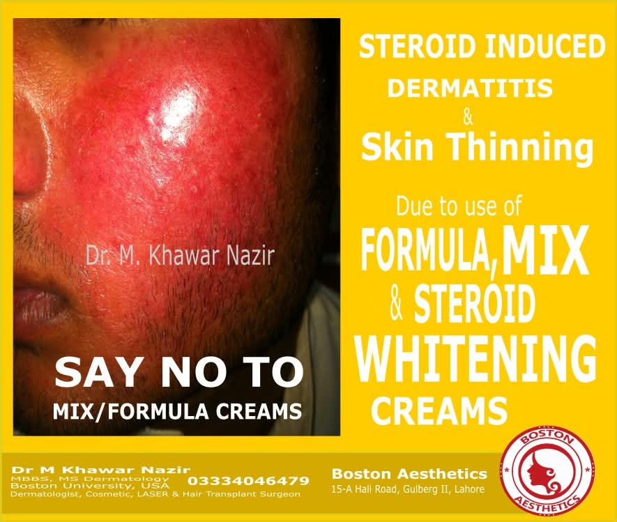 Dermatology awareness poster by Dr. M. Khawar Nazir, Boston Aesthetics Lahore, showing steroid-induced dermatitis and skin thinning on the face caused by long-term use of formula, mix and steroid whitening creams.